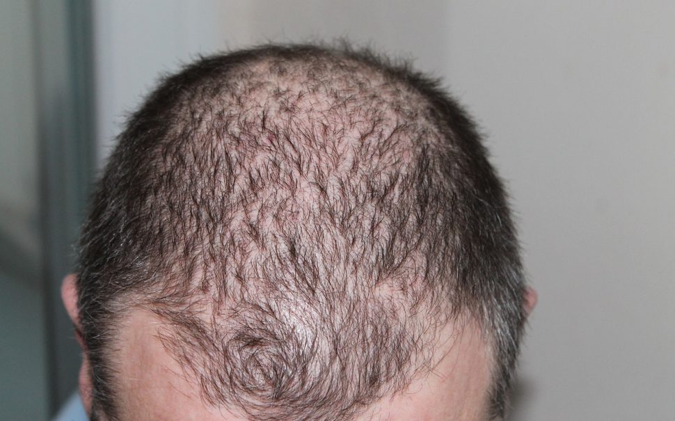 Man with hair loss